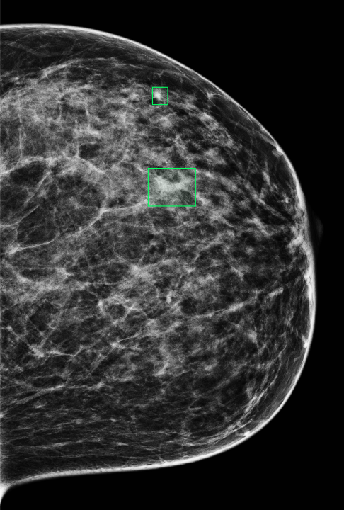 Left synthetic mammogram