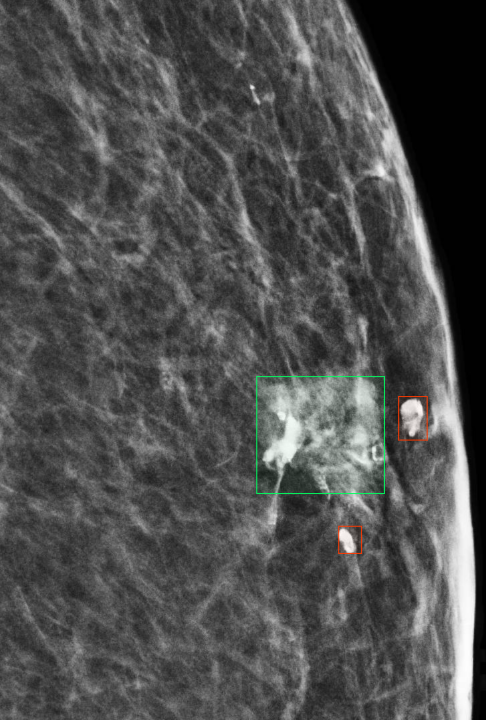 Right synthetic mammogram