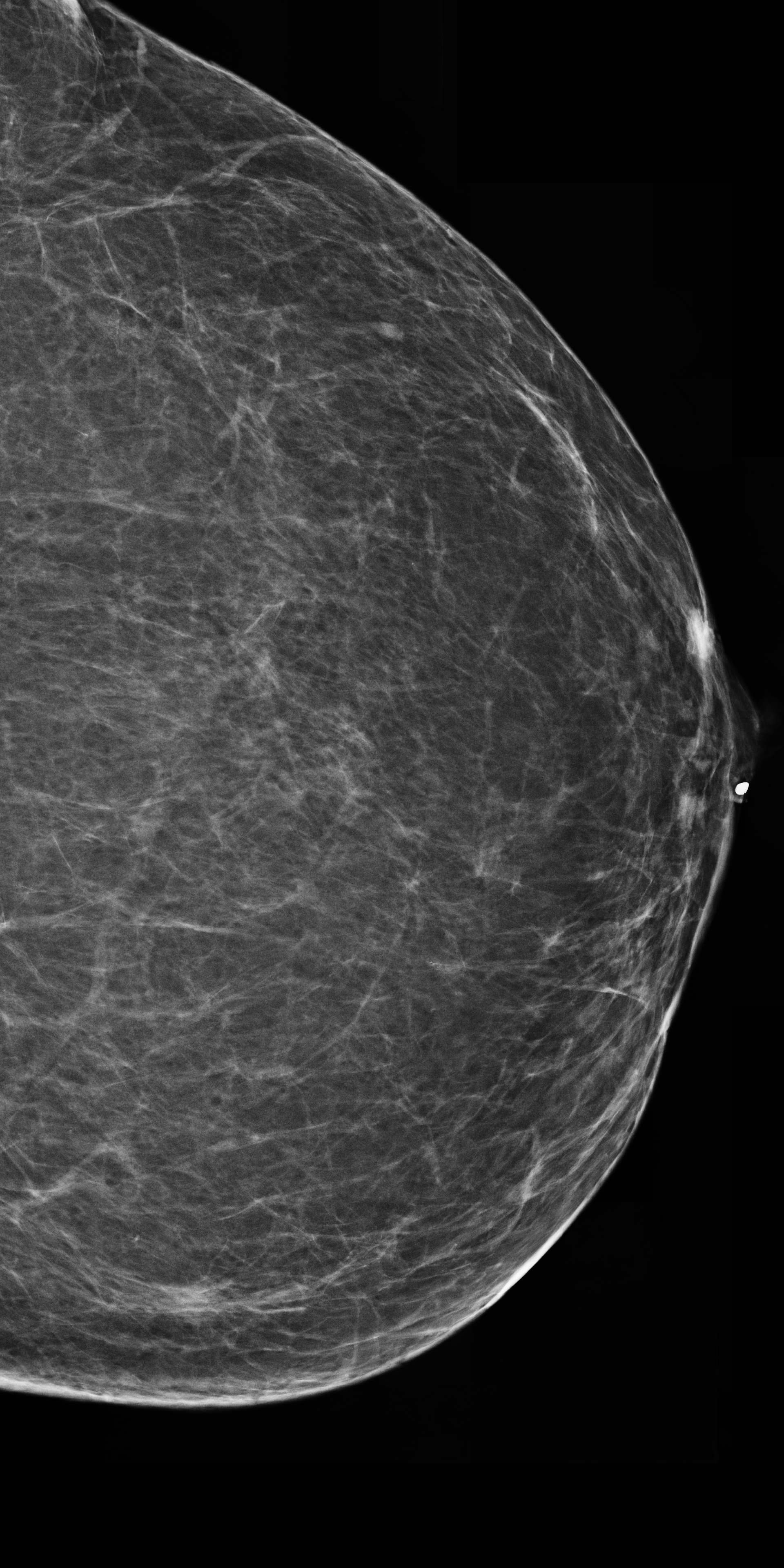 Left synthetic mammogram
