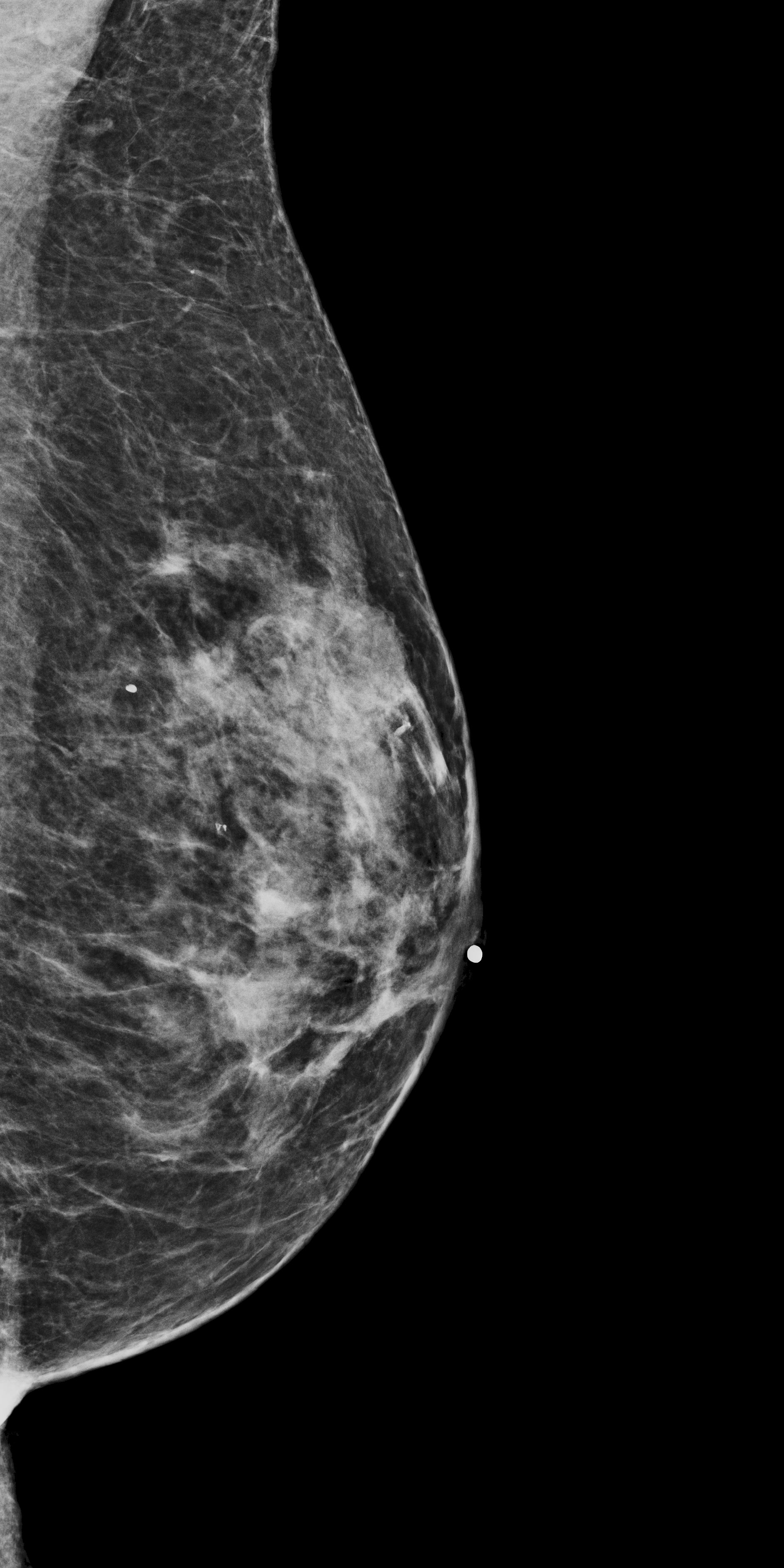 Right synthetic mammogram